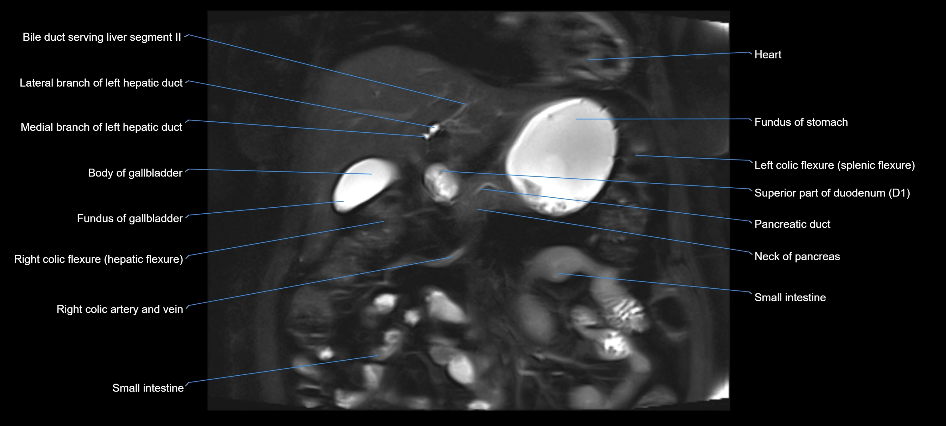 MRI MRCP coronal cross sectional 3T radiology  image-img-00001-00008.webp